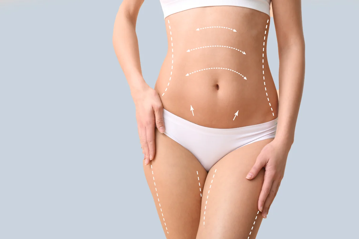 Liposuction Facetite – Bodytite and Acutite