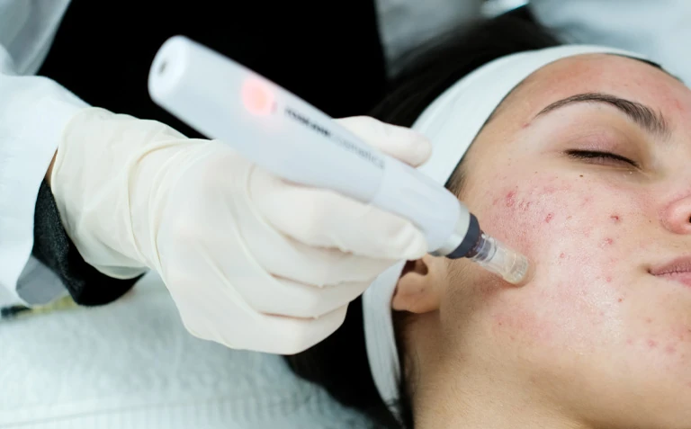 Medical microneedling with Dermapen