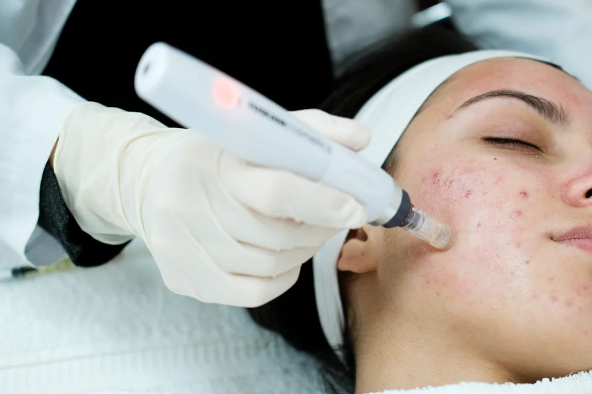 Medizinisches Microneedling mit Dermapen Medizinisches Microneedling mit Dermapen